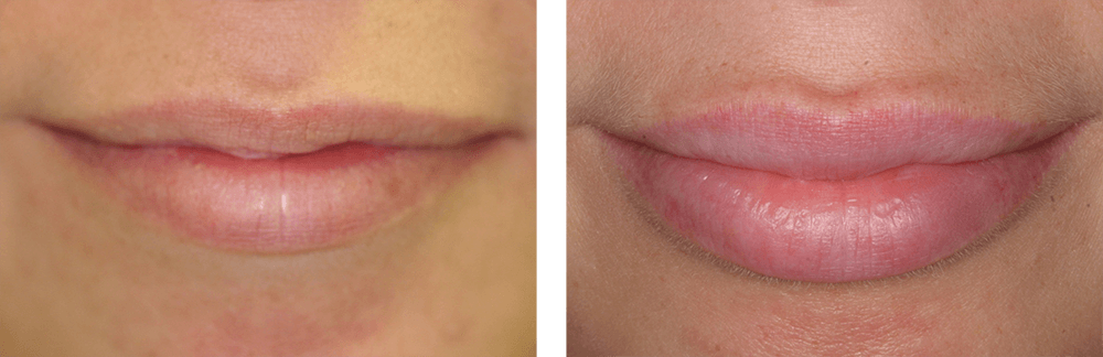 JUVÉDERM lips before and after